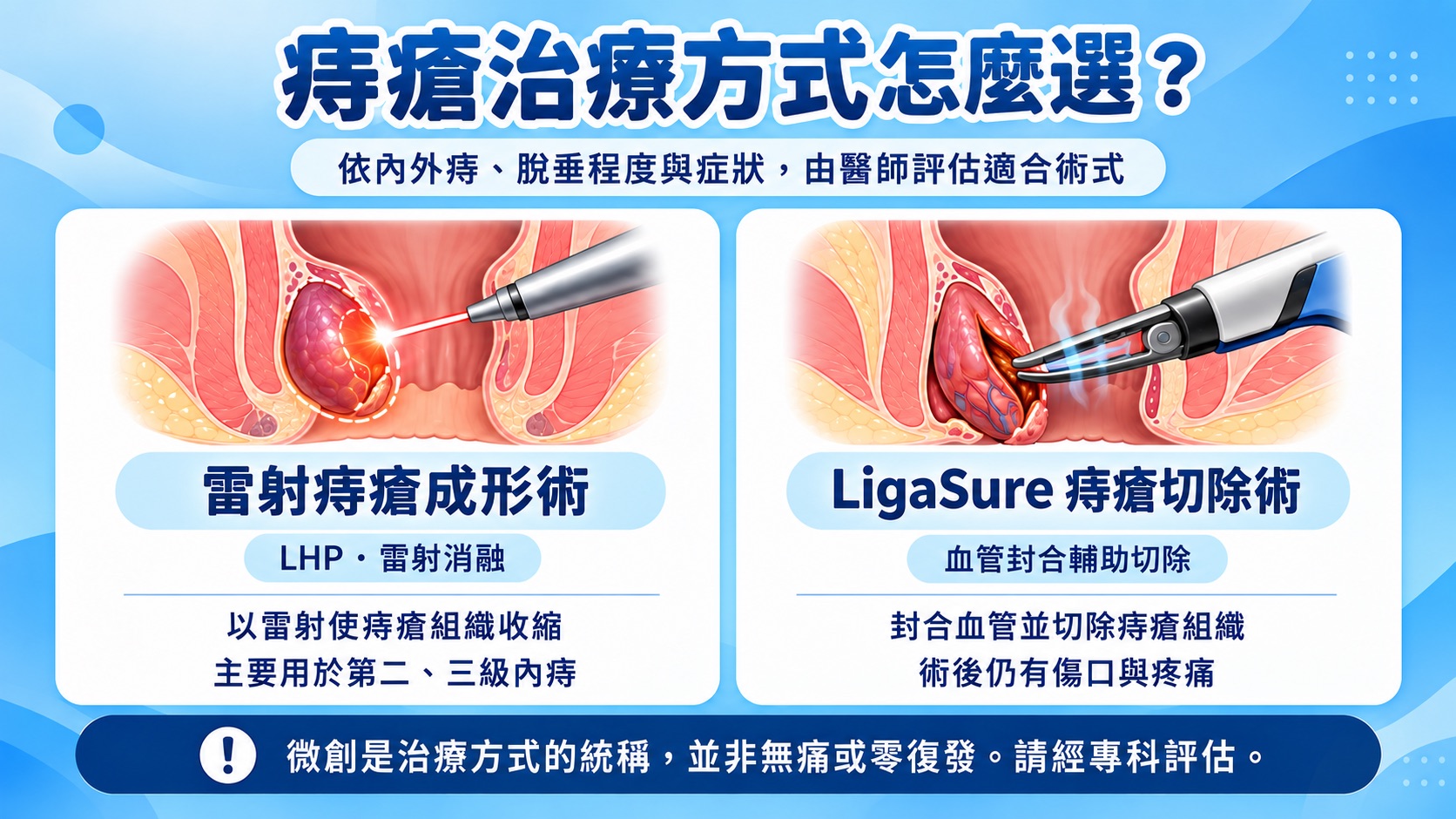 雷射痔瘡消融與 LigaSure 痔瘡切除手術比較